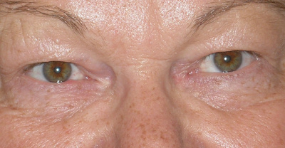 Blepharoplastik